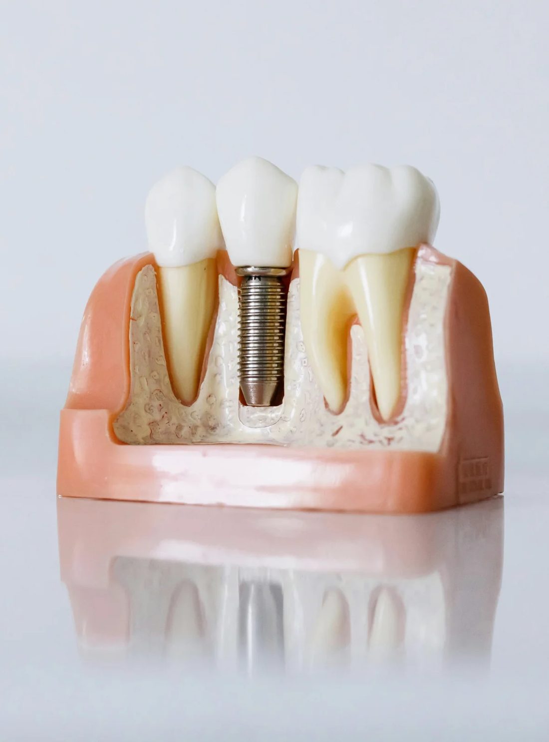 Dental implants