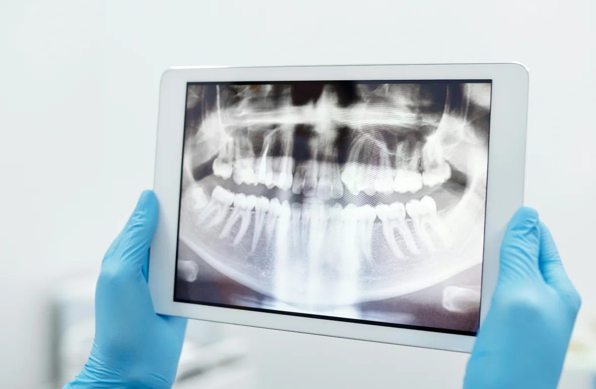 Invisalign clear aligners